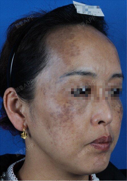 昨天是第二次去维美做激光祛斑了,去医院的途中心里还_圈子-新氧美容