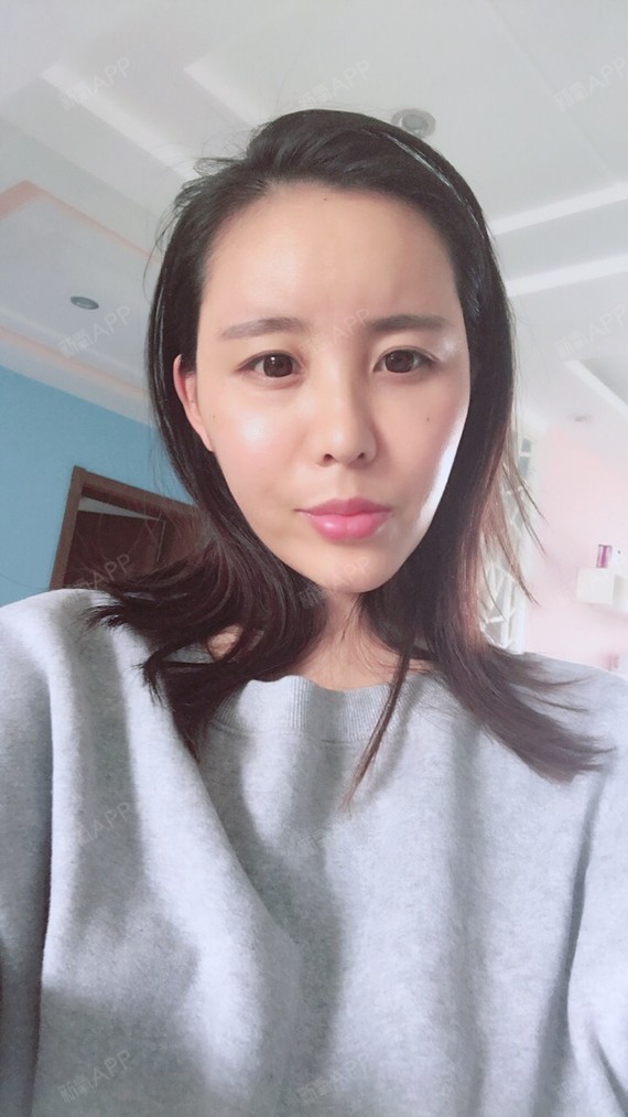 自体脂肪填充全脸
