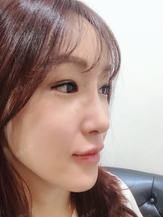 耳软骨复合隆鼻好不好_效果图_叼着奶瓶耳软骨复合隆鼻术后第20天