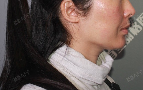 最大的感受就是鼻唇沟浅了很多,肿的也没有那么厉害,_圈子-新氧美容