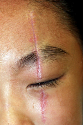 元气少女琪琪的美丽日记"4.10"手术祛疤