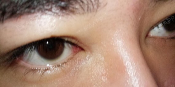 下面是三张图这个是开眼角留下的凹陷疤痕已经2年了各_圈子-新氧美容
