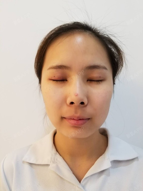 埋线双眼皮