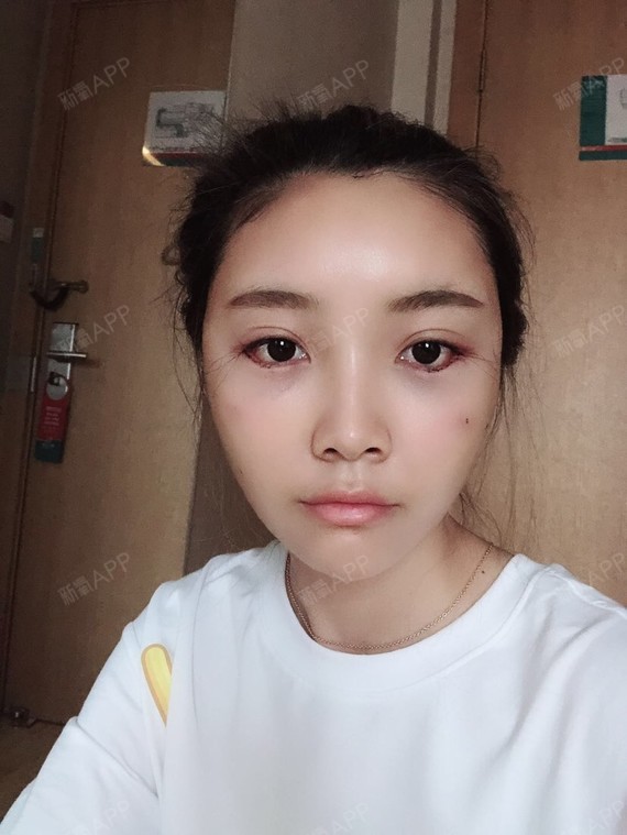 【南京柠檬医美外眼角下至术后第5天】
