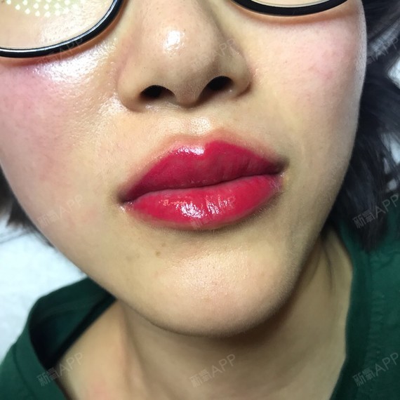 一直想做个嘴唇,于是在氧气上逛了好就_圈子-新氧美容整形