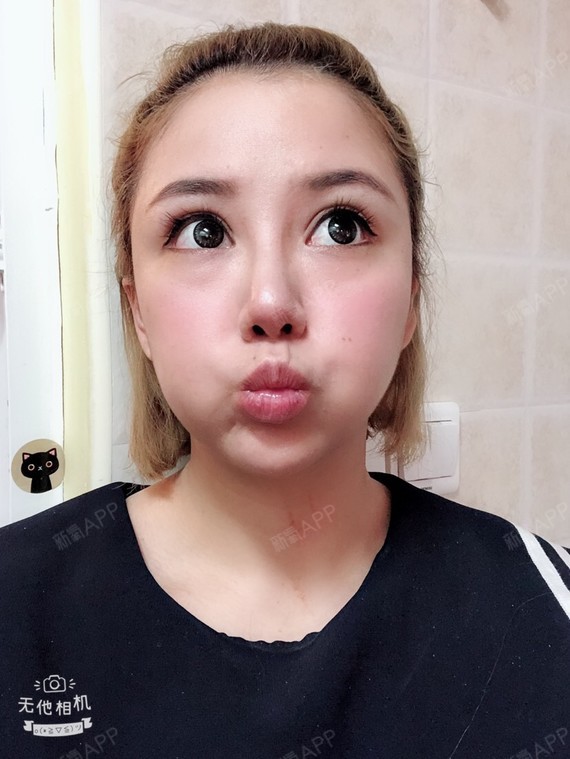 重庆耳软骨复合隆鼻好不好_效果图_虎妞扭扭耳软骨复合隆鼻术后第154