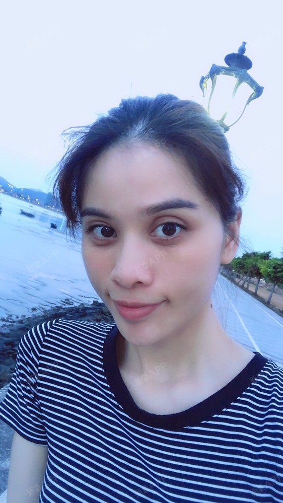 医院推荐我全切双眼皮,切完马上抽脂肪填充凹陷的眼窝_圈子-新氧美容