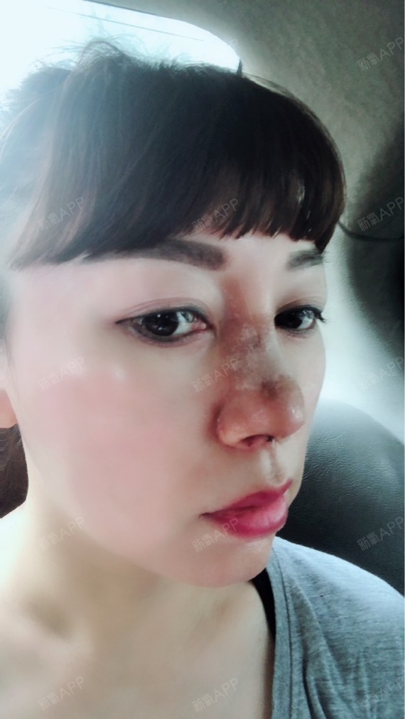 第五天啦,感觉鼻子又消肿了一点,但是伤口还是看得见_圈子-新氧美容