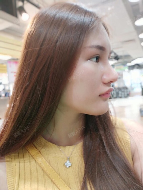 【膨体垫下巴34天】现在下巴恢复得越来越自然,刚做_圈子-新氧美容