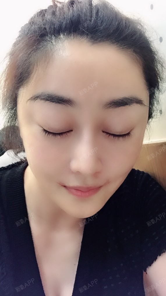 种植眉毛