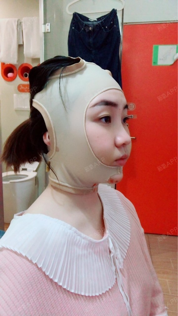 自体脂肪垫下巴