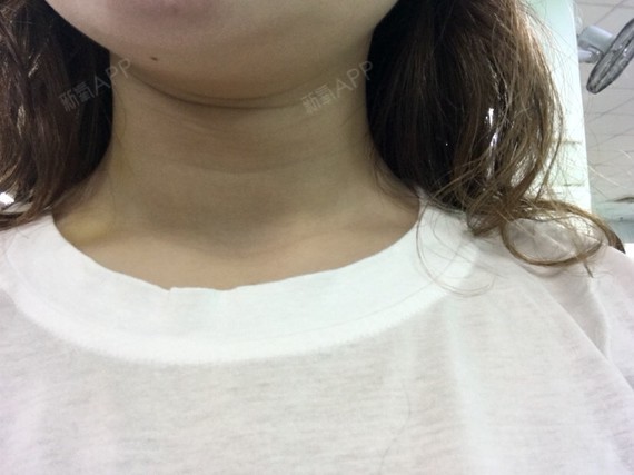 我的脖子可以说是非常短了,又很粗01我真的不是被上天_圈子-新氧