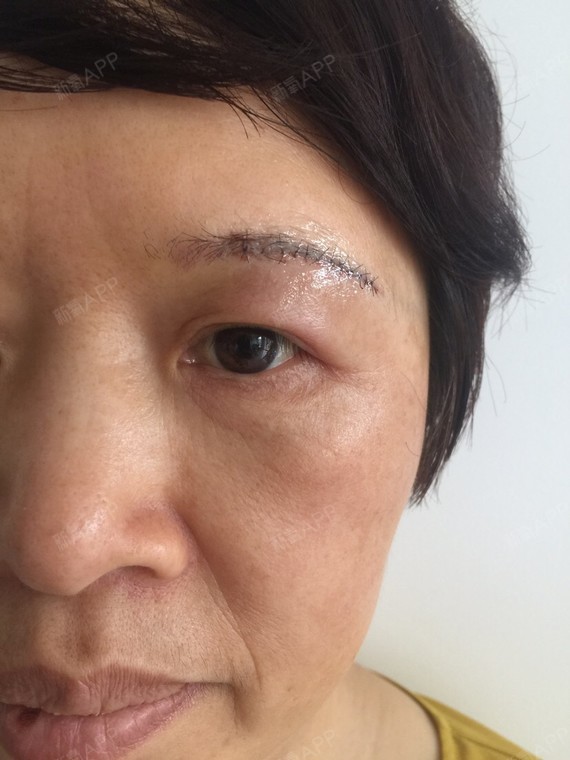 新氧- 木兰情 | 眼部 | 术后当自强 | 切眉术 | 上眼睑 | 赣州同城