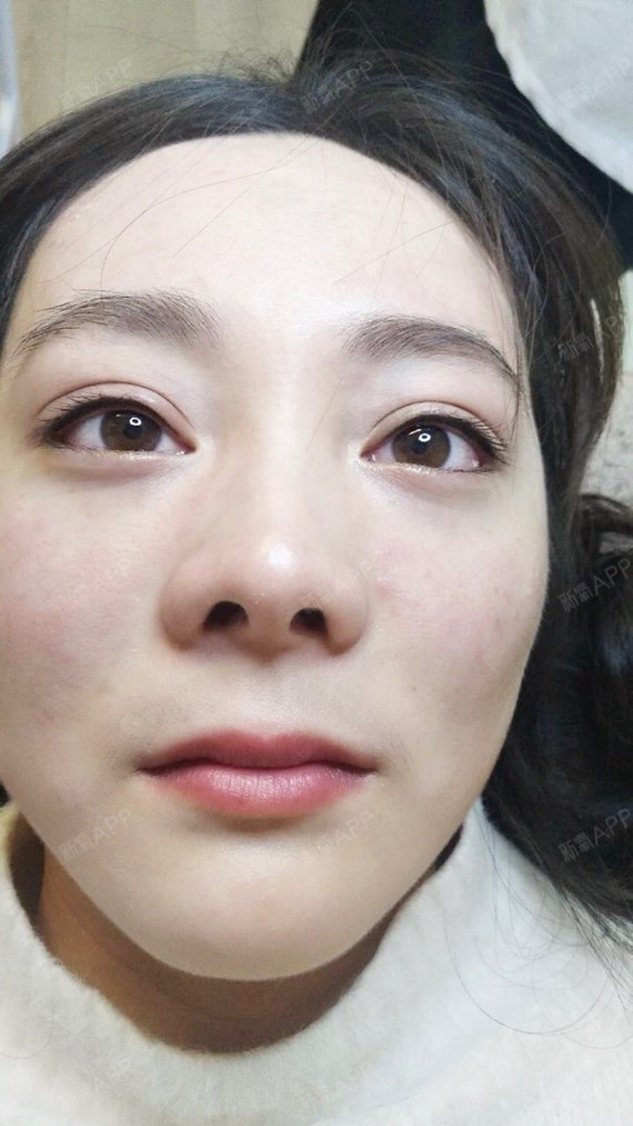 上海半永久美瞳线好不好_效果图_氧气xwqwd半永久美瞳线术后第0天