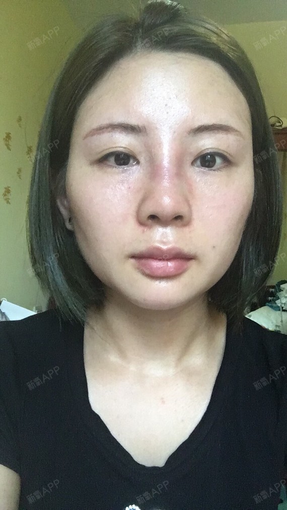 我做了鼻部多项现在已经24天了鼻子三根那里肥大,很