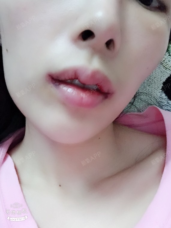 五天后拆线,今天刚好第六天,拆线我真是醉了,我们这_圈子-新氧美容