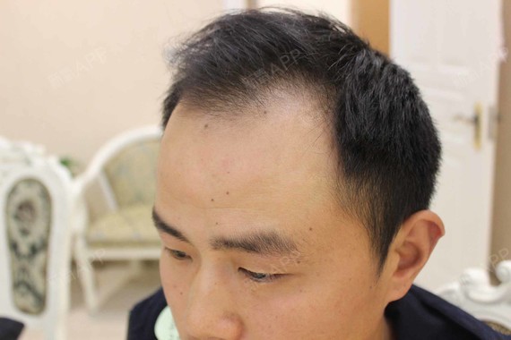 整容植发男上海(上海植发整个头顶多少钱)