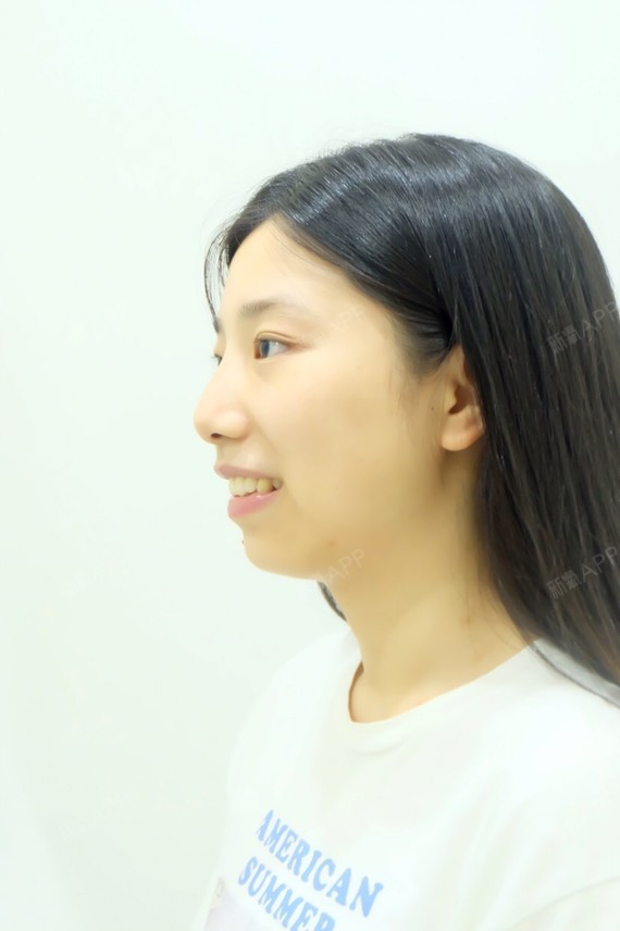 新氧- 晗晗溪溪 | 牙齿 | 牙齿矫正 | 牙齿美容 | 种植牙 | 烤瓷牙