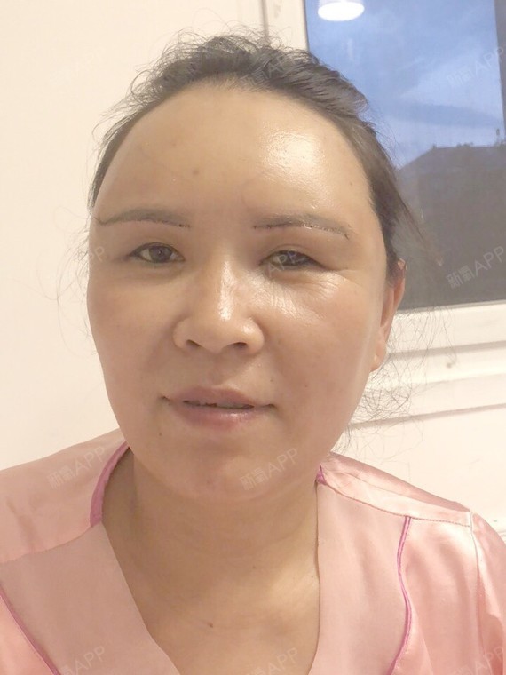 清风拂过我的大脸子切眉术第7天美丽日记-新氧美容整形