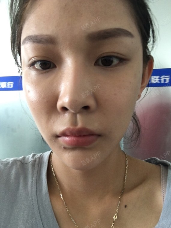 我去打的玻尿酸完全打的很失败她们那个高院长打得实在_圈子-新氧美容