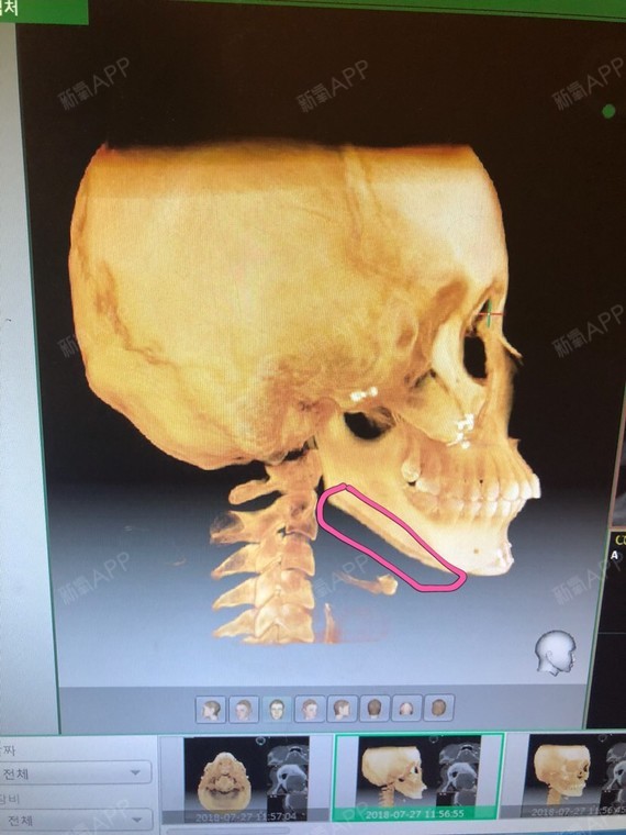 这个是侧面的骨头