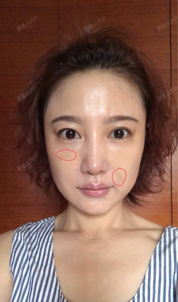 面部轮廓 | 术后当自强 | 埋线提升 | 北京同城 | 脸颊 | 抗衰抗初