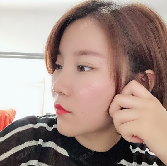 线雕隆鼻术后第二天
