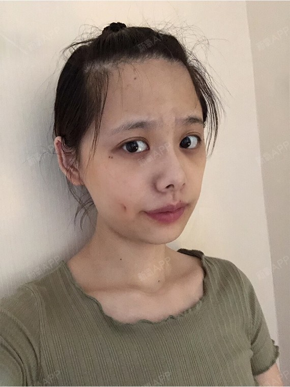 喜欢佟丽娅的小梨涡,浅浅的但又很特别,知道可以人_圈子-新氧美容整形