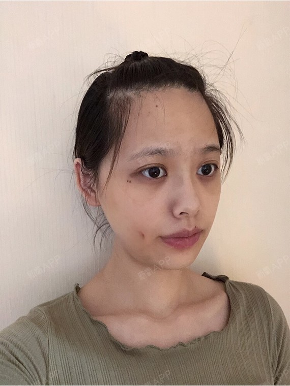 很喜欢佟丽娅的小梨涡,浅浅的但又很特别,知道可以人_圈子-新氧美容