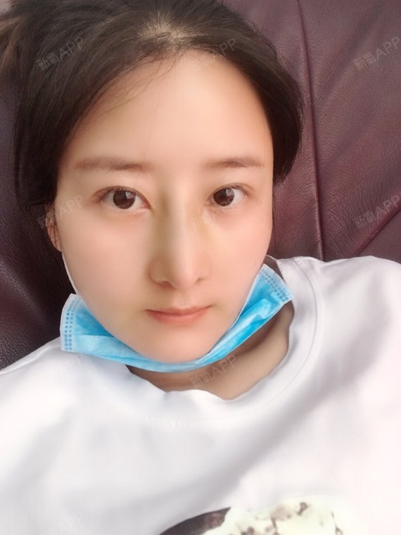 琪小小1991肋软骨隆鼻第10天美丽日记