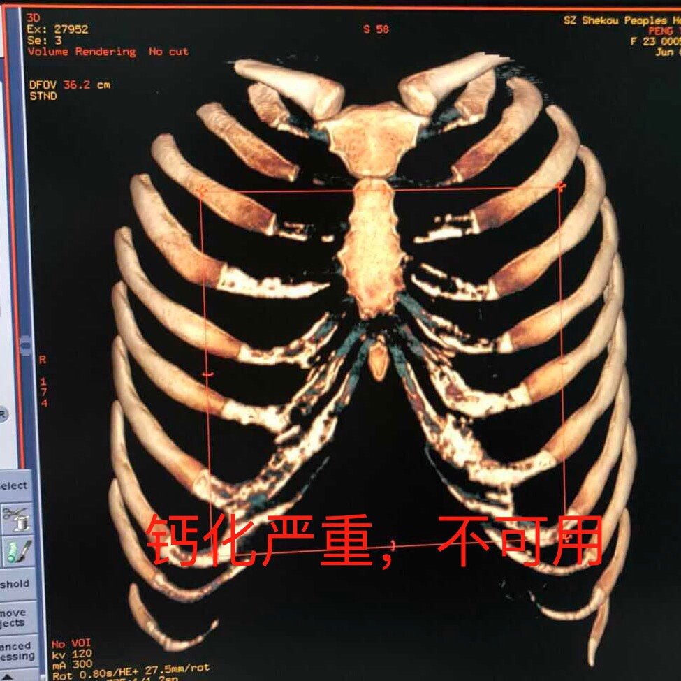 【老李说鼻子】#鼻整形科普#肋软骨钙化现象,指在x线片上显示为肋骨的