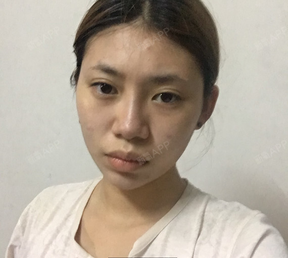 期待已久的硅胶假体下巴今天昨天下_圈子-新氧美容整形