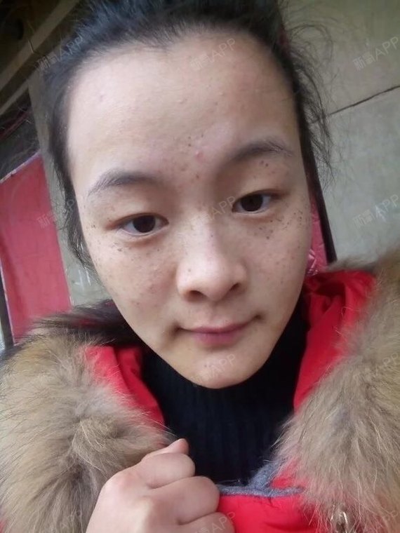 氧气xwrzx激光祛斑第15天美丽日记