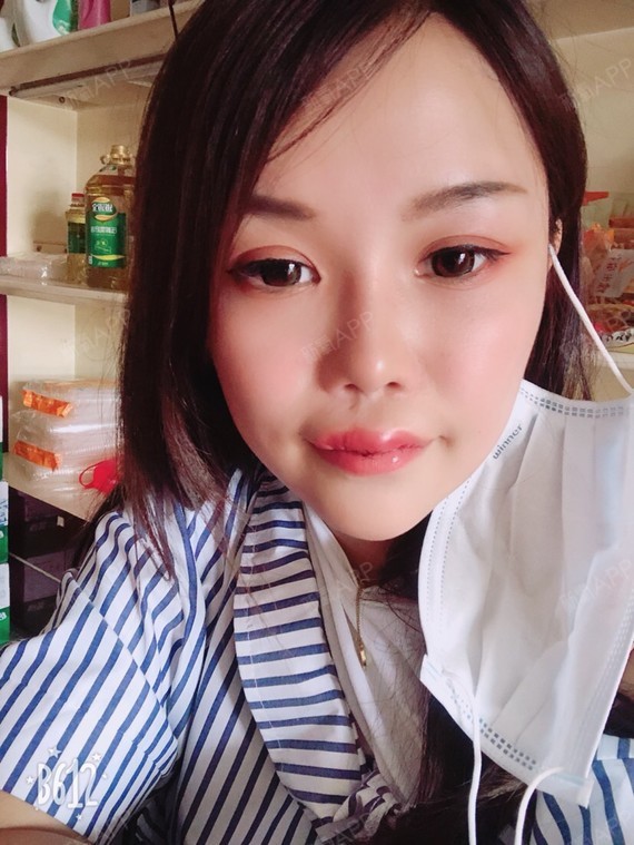 氧气xtqjcm唇手术术后第7天美丽日记_新氧整形