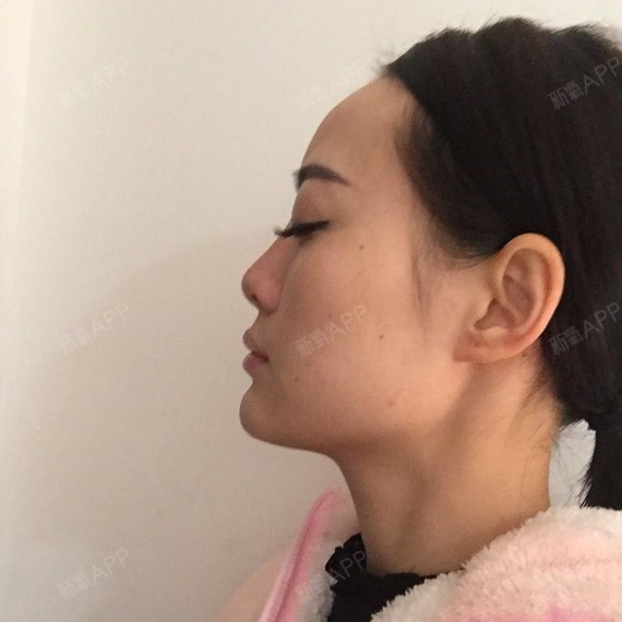 【鼻部多项术后第2天】亲爱的仙女们,今天单独写一篇隆鼻的日记.