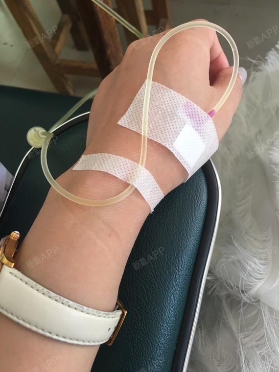 美白针好不好_效果图_氧气ye4882f美白针术后第27天_新氧美容整形