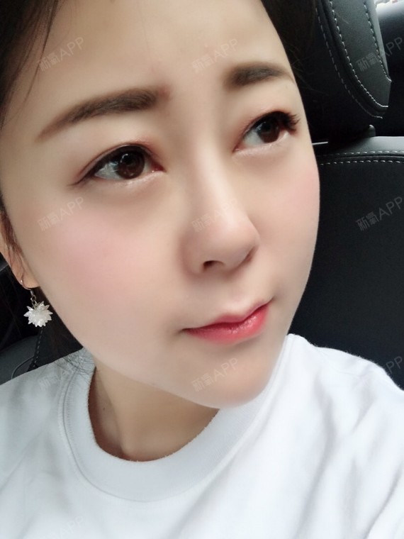 女神爱赚钱玻尿酸垫下巴第75天美丽日记
