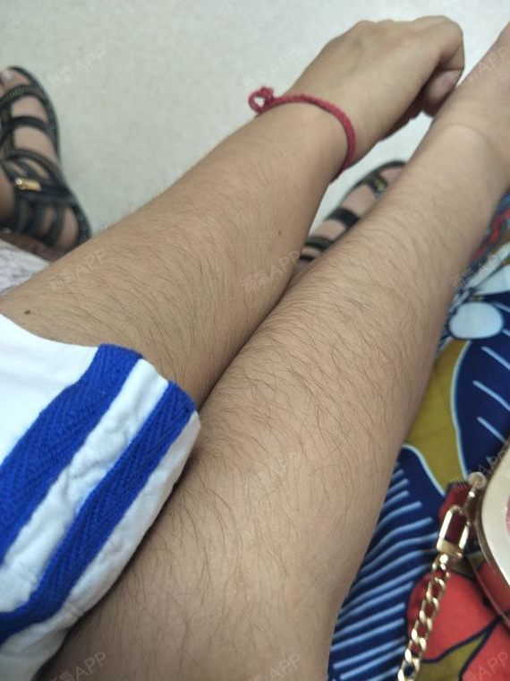 在医院碰到一个也是脱手臂毛妹子,我们都是属于体毛比_圈子-新氧美容