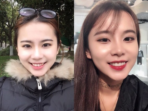 女孩子有一副整齐的白牙有多重要-记我的美牙日记