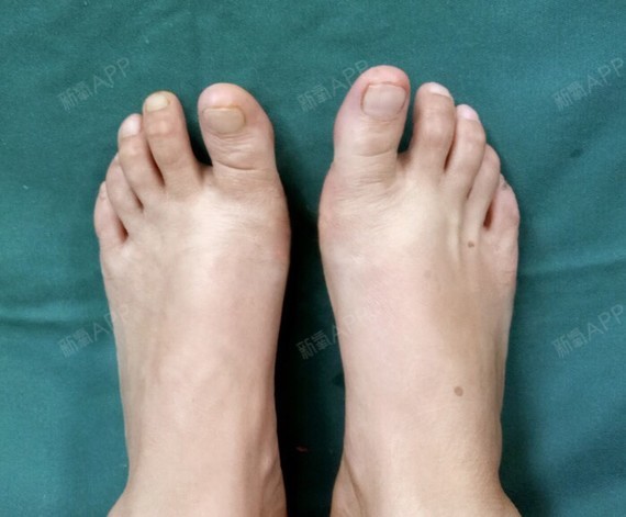 我一直很自卑,平时出去都很少露自己的脚_圈子-新氧美容整形