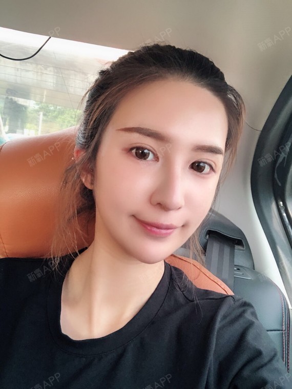 陌小羽自体脂肪全脸填充第15天美丽日记