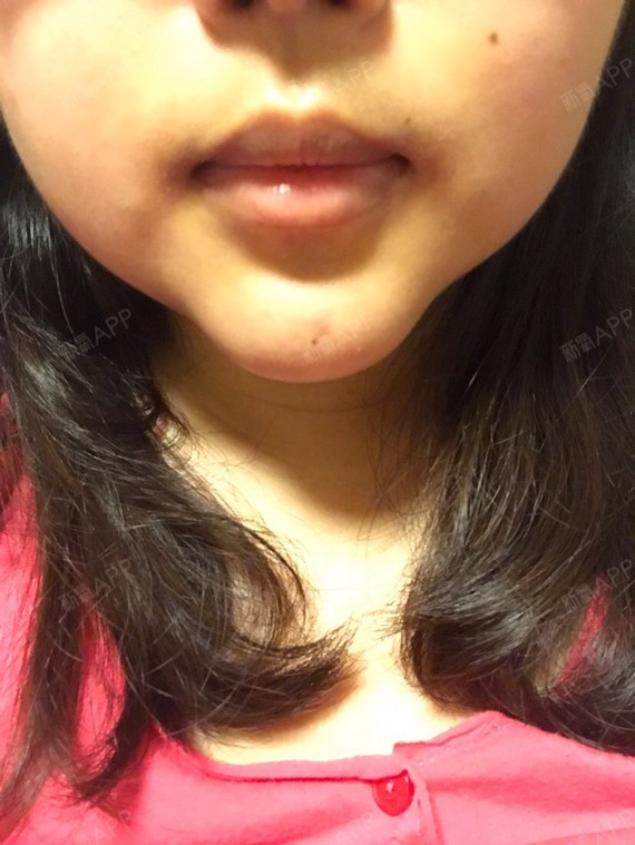 截骨前移14天,原来是圆脸小下巴,做完变成这样,上_圈子-新氧美容整形