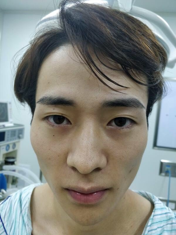 福州爱美尔整形切开双眼皮怎么样_恢复过程_效果如何_方大人整形日记