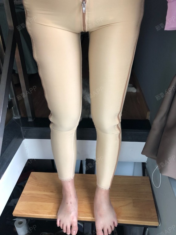 吸脂瘦小腿项目术后第6天