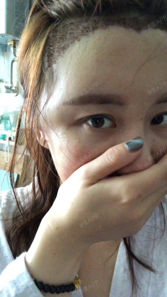 今天额头超级肿,太阳穴也很肿