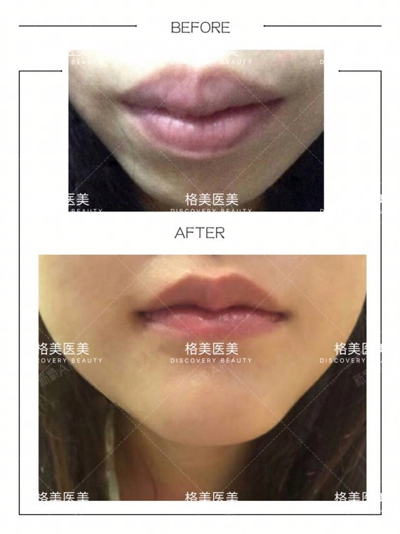 【整形修复专家黄印资教授】问:厚唇改薄手术会影响嘴_圈子-新氧美容