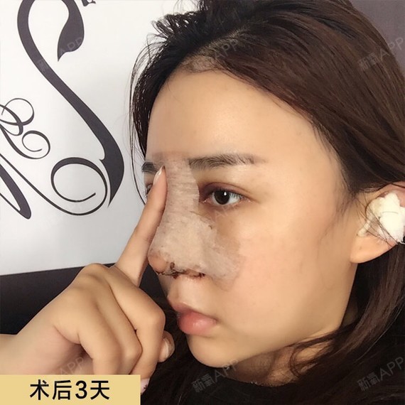 离小仙女只差一个鼻子名字:小念术前特征:鼻根