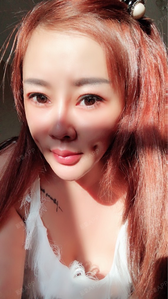 酒窝成型5天…脸上好大两个坑……做的不同拆线的…太难看了