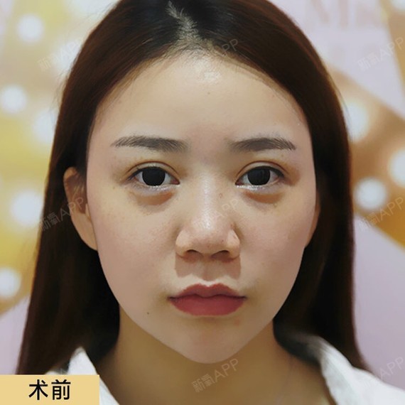 离小仙女只差一个鼻子名字:小念术前特征:鼻根