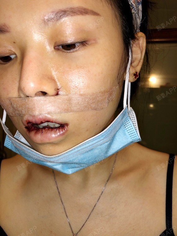 今天m唇第一天呢,术后有点肿,经绷的很